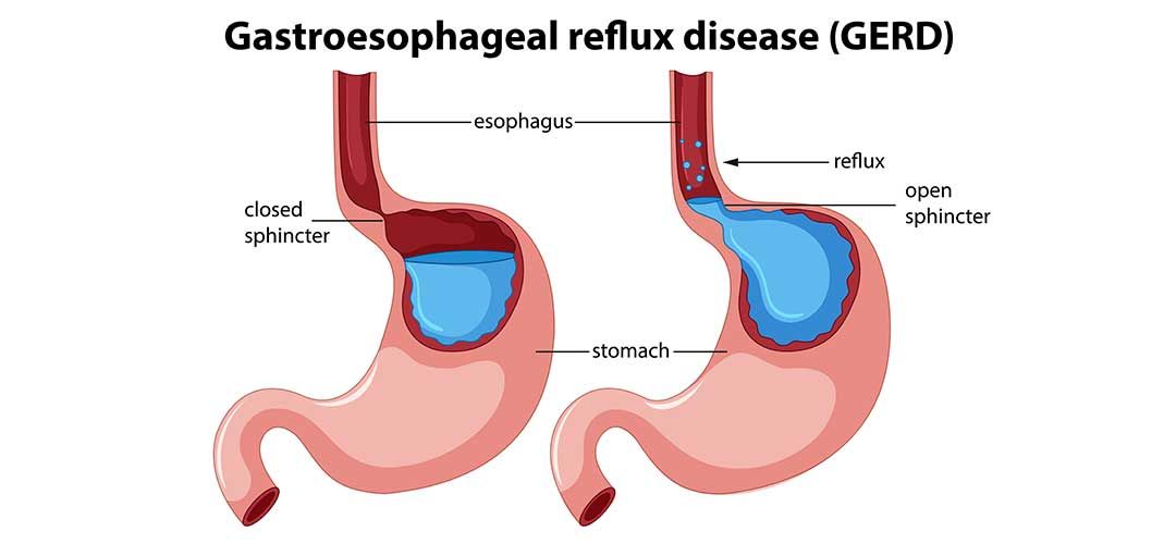 what is Gastroesophageal Reflux Disease or GERD?